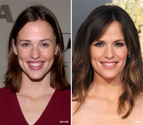 Jennifer Garner Before and After Plastic Surgery